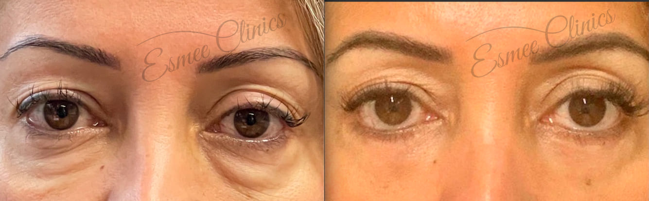 Before and After img